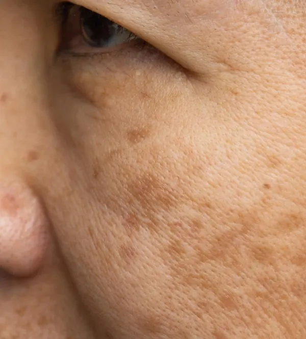 This close-up shows melasma, a common form of hyperpigmentation. My treatment focuses on a combination of sun protection, tyrosinase inhibitors to block pigment production, and gentle procedures like Q-switched lasers to gradually break down existing melanin.