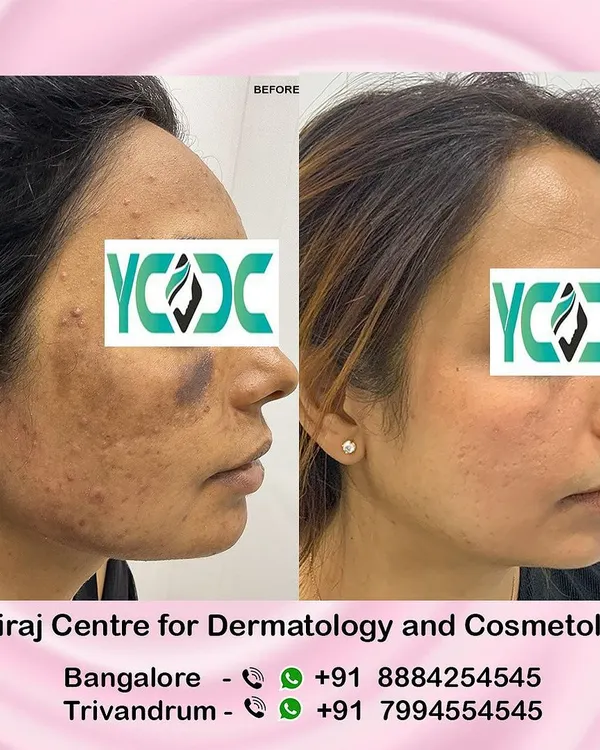 This is the powerful result of real medical care. We corrected severe skin damage and deep pigmentation for this patient, which was caused by a treatment from an unqualified practitioner. This transformation shows our commitment to restoring skin health safely and effectively.