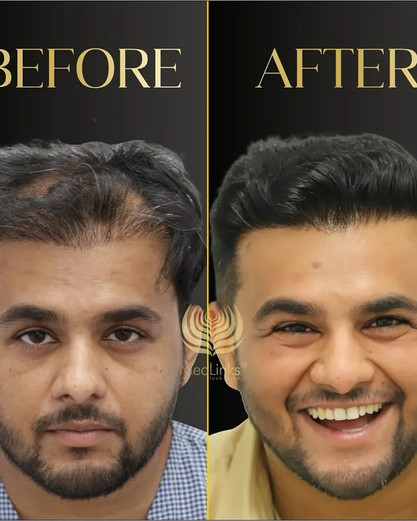 The smile says it all. This patient came to us with significant hair loss and left with renewed confidence. This before and after result shows the dramatic yet natural-looking change possible with a well-planned hair transplant.