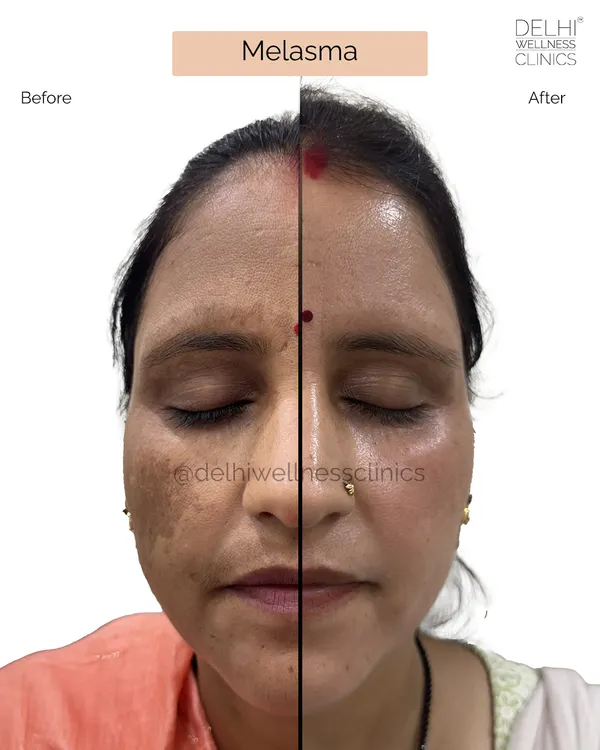 This is the kind of transformation that makes our work so rewarding. This client was struggling with stubborn melasma, and through a personalized treatment plan, we were able to significantly reduce the pigmentation, revealing clearer, more even-toned, and glowing skin.