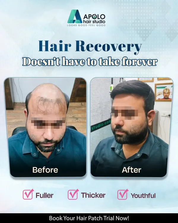 A classic example of how our non-surgical hair patch for men can reverse the appearance of years of hair loss. This client now enjoys a full, thick hairstyle that is easy to manage.