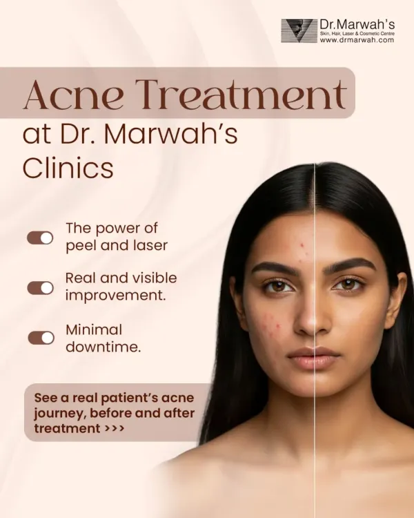 This before-and-after image shows the visible improvement in a patient's skin after a customized acne treatment plan. We combined the power of a targeted chemical peel and advanced laser therapy to calm active breakouts, reduce inflammation, and improve overall skin texture with minimal downtime.
