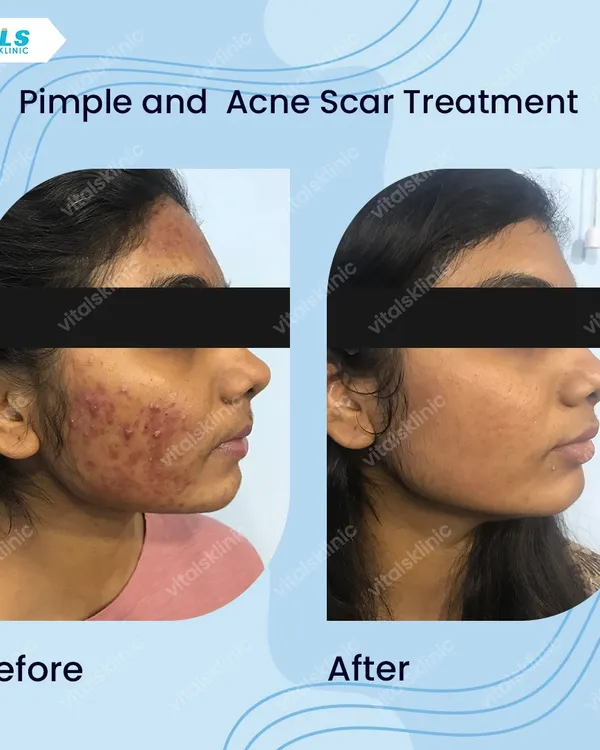 This is the result of a scientifically designed treatment plan for persistent acne and scarring. My approach goes beyond surface treatments to address the root cause, leading to clear, healthy skin and renewed confidence.