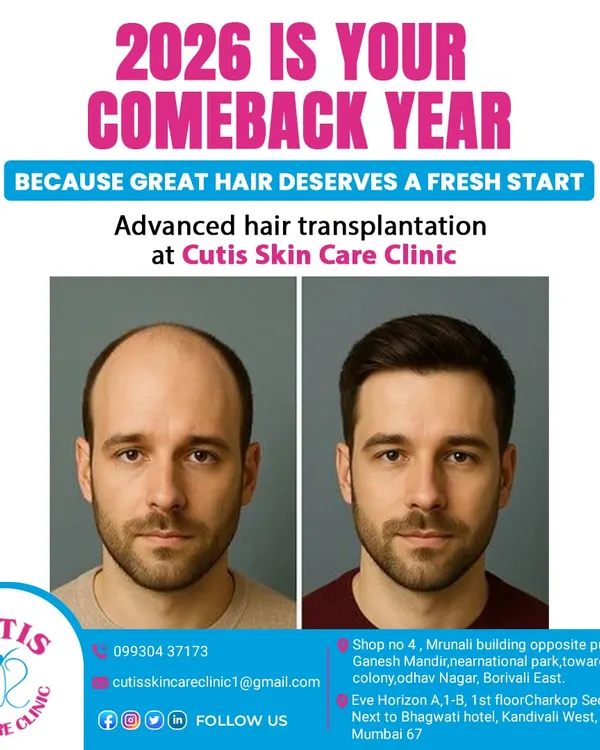 This before and after comparison is a testament to the life-changing results of our hair transplant surgery. The patient's hairline is fully restored, and the density creates a youthful, natural appearance that is virtually indistinguishable from a natural head of hair.