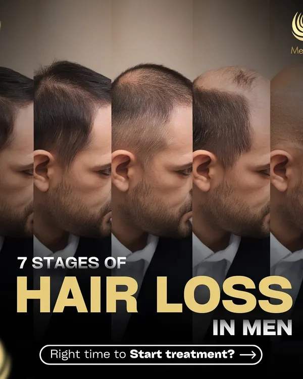 Hair loss happens in predictable stages. This series will help you understand the 7 stages of male pattern baldness and identify the right time to start treatment.