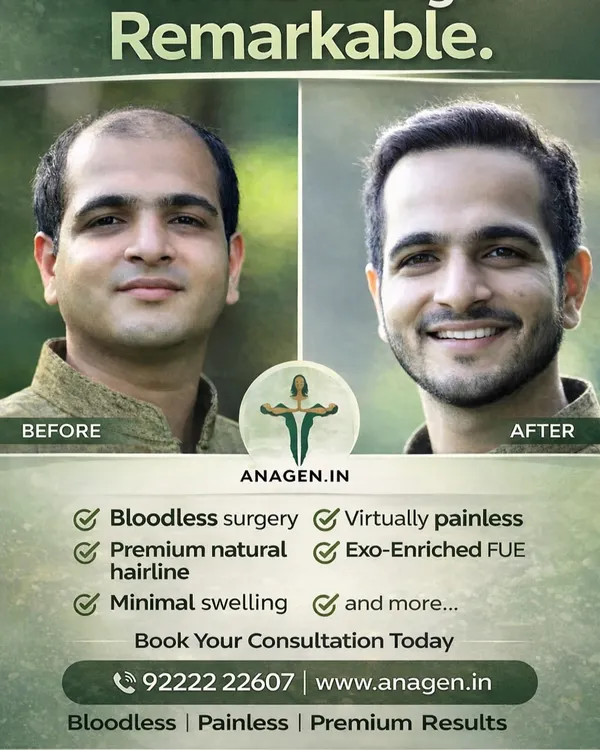 This is what we mean by a remarkable transformation. We don't just transplant hair; we artistically design a premium, natural hairline that restores your youthful look and, more importantly, your confidence.