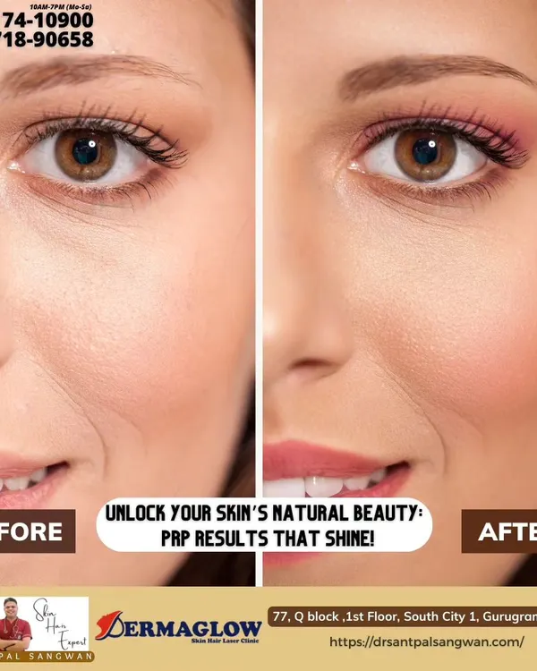 This before-and-after image shows the real results of my Platelet-Rich Plasma (PRP) treatment. Notice the significant reduction in fine lines and improved skin texture around the eye, resulting in a brighter, more youthful appearance. This is what I mean by restoring your skin's natural beauty.