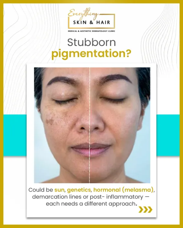 Stubborn pigmentation is one of the most common concerns I see, especially for Indian skin. Whether it's caused by sun exposure, genetics, or hormonal changes like melasma, a correct diagnosis is the first step towards clear, even-toned skin.