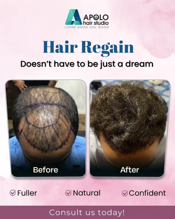 Regaining your hair is not just a dream. This before and after comparison shows a complete transformation, covering the crown area to achieve a fuller, natural, and more confident look.