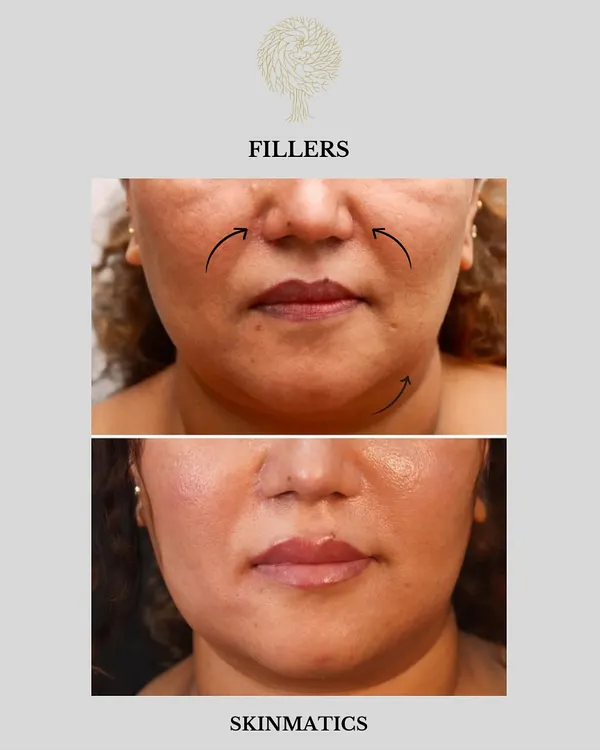 This is a great example of a full-face rejuvenation using dermal fillers. We addressed the cheeks, nasolabial folds, lips, chin, and under-eye area to restore youthful volume and create a harmonious, lifted appearance.