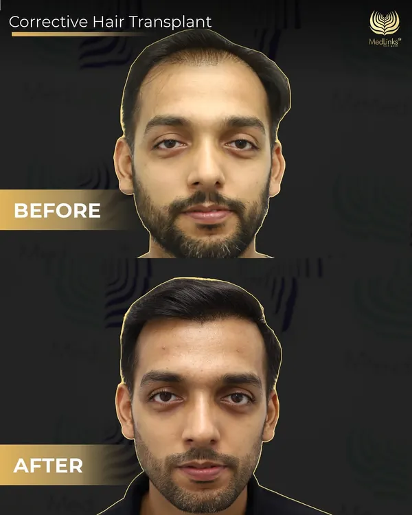 This is a frontal view of a corrective hair transplant. The 'before' image shows an unnatural, pluggy hairline from a previous procedure elsewhere. Our 'after' result demonstrates a soft, natural, and dense hairline that completely corrects the past mistake.