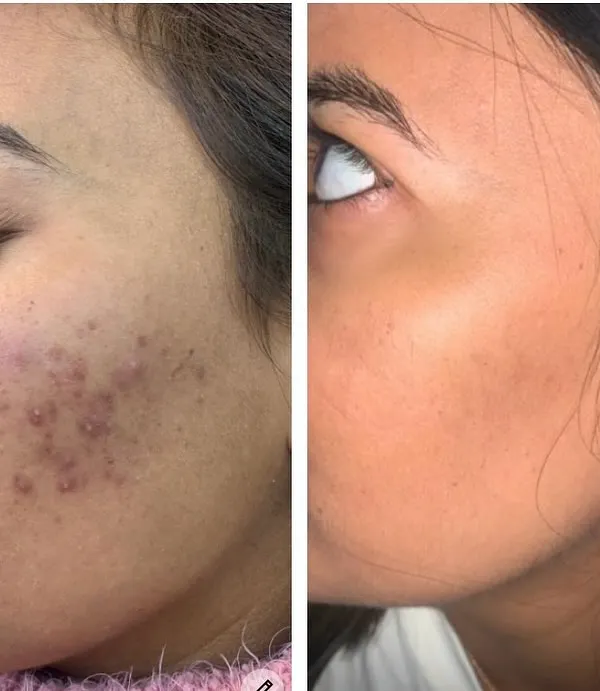 This is a clear example of the results we can achieve for post-acne blemishes and inflammation. After a series of six personalized chemical peel sessions, you can see a significant reduction in active acne and a dramatic improvement in skin texture and tone. My goal is always to restore the skin's health, not just treat the surface.