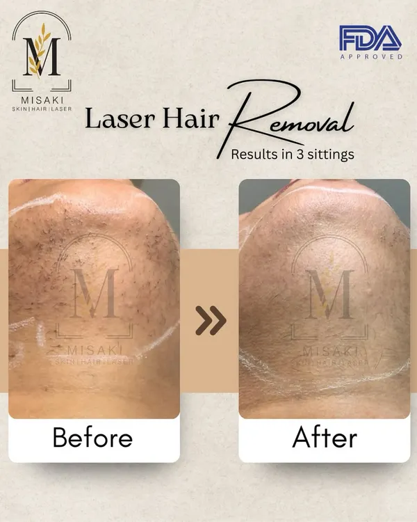 This is the kind of result you can expect. This before and after image shows a significant reduction in hair on the chin and neck area after just three sittings, leading to smoother skin texture.
