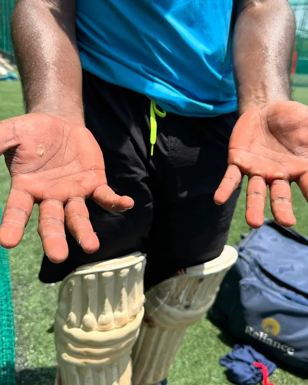 The hands of a batsman after a long session. This is what dedication looks like. The blisters are temporary, but the skill is permanent.