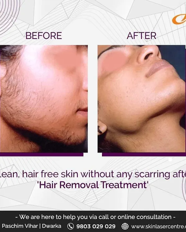 This before and after shows the effectiveness of laser hair removal on the face, resulting in clean, hair free skin without scarring. This is a common treatment for achieving a smoother complexion.