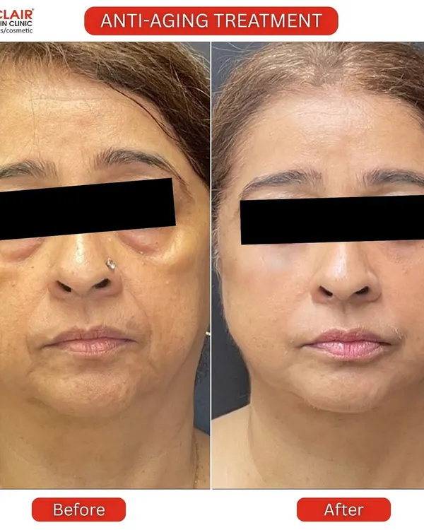 This is the power of a personalized anti-aging plan. This before and after showcases a comprehensive treatment that visibly reduced under-eye hollows, softened deep lines, and restored a firmer, more youthful contour to the face for a naturally refreshed appearance.
