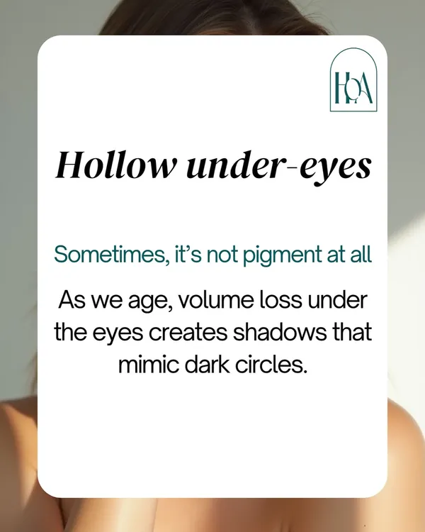 Sometimes, what you think are dark circles are actually hollow under-eyes. As we age, volume loss in this area creates shadows that mimic pigmentation. This is a concern that eye creams can't fix, but fillers can.