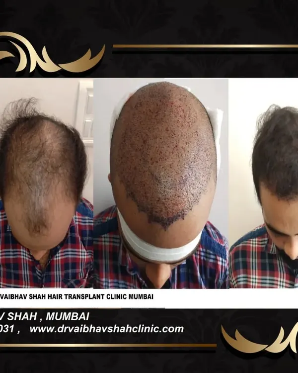This series shows the complete journey for a patient with advanced baldness: from the initial state, to the scalp immediately after graft implantation, and finally the grown-out result.