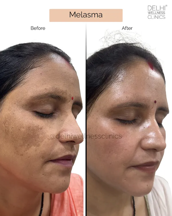 This side-profile view shows the significant reduction in melasma on the client's cheek. Our targeted approach ensures we address the deepest layers of pigmentation for lasting results.