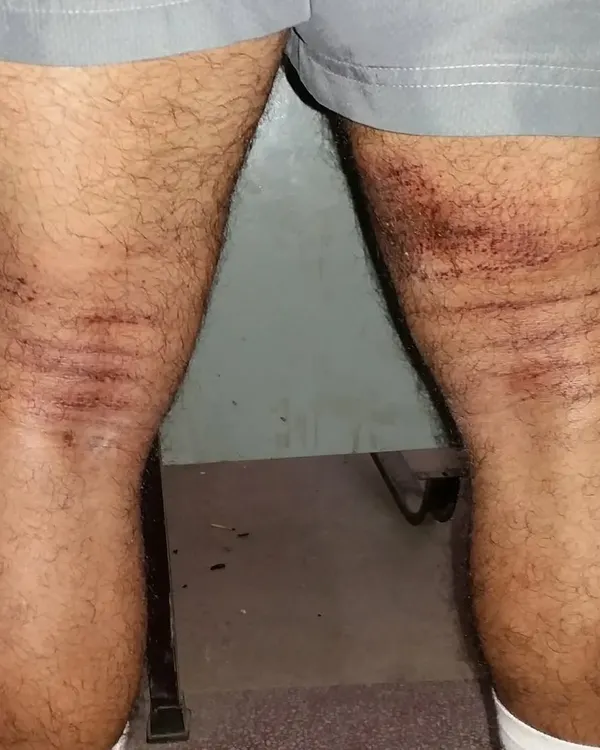 This is the sweet pain of equipped lifting. These scrapes on my legs are from a tight deadlift suit. If someone says equipped is easy, they have never tried it.