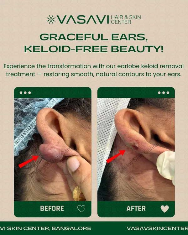 This image shows the significant reduction of a large earlobe keloid. My focus is on not just removing the keloid but also restoring the natural shape of the ear, providing both a physical and confidence-boosting transformation.