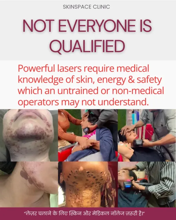 This is the unfortunate result of laser procedures performed by untrained individuals. At my clinic, every treatment is doctor supervised using only medical grade technology because your safety is my absolute priority. Aapki skin anmol hai, don’t risk it with shortcuts.
