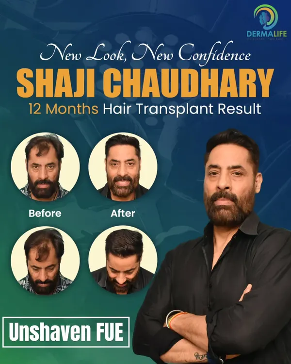 This is the result of actor Shaji Choudhary's Unshaven FUE transplant after 12 months. My focus is always on creating a natural hairline that restores a youthful look and boosts confidence, which is especially important for actors who need versatile hairstyles.