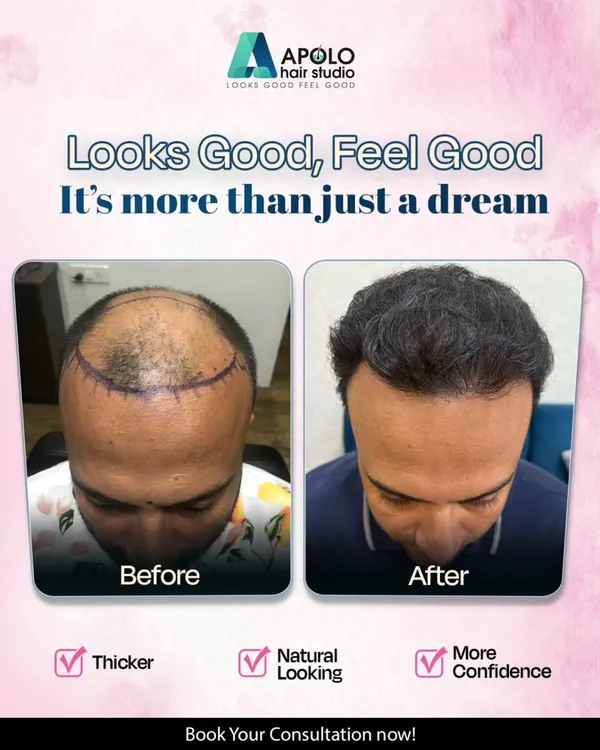This is the result we strive for with every hair transplant. The goal is not just to add hair, but to restore a natural, thicker hairline that boosts your confidence and makes you feel good.