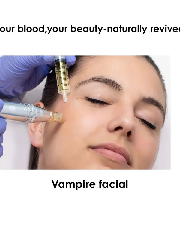 The Vampire Facial uses your own blood's healing power to rejuvenate your skin. This image shows the application of PRP with a microneedling device, which helps the growth factors penetrate deeply to stimulate collagen and repair the skin from within.