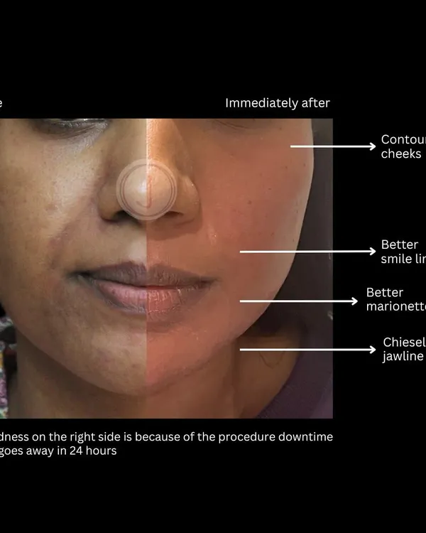 A detailed look at the immediate results of a facial contouring session. We enhanced the cheekbones, improved the appearance of marionette folds, and defined the jawline for a subtle lift.