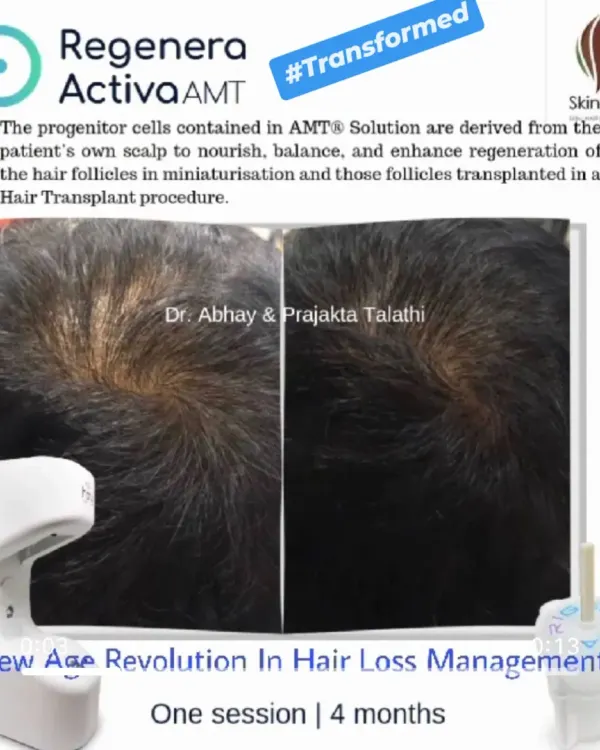 This transformation was achieved after just one session of Regenera Activa, with results documented at 4 months. The treatment effectively increased hair density and coverage at the crown, a common area of concern for male pattern hair loss.