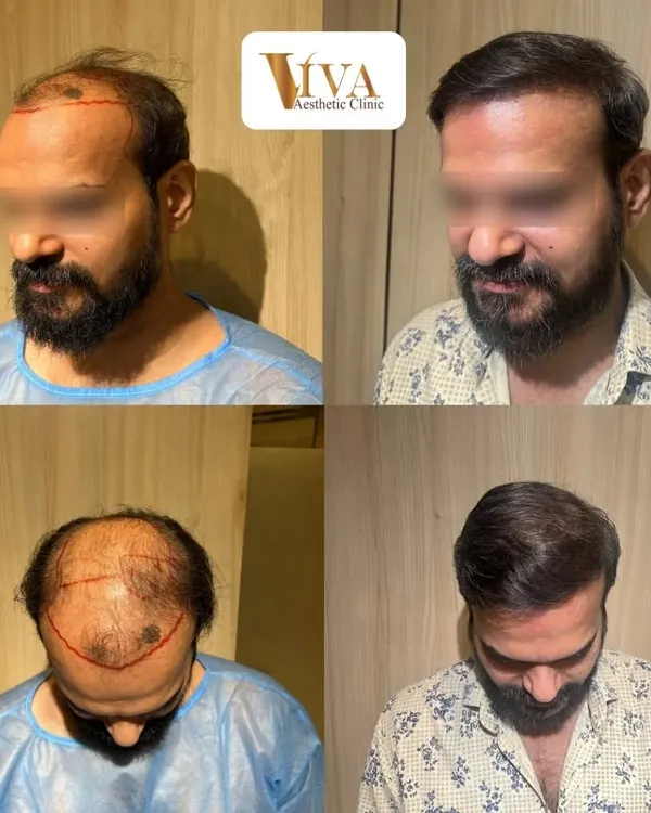 This patient's journey is a powerful example of regaining confidence. The before and after photos speak for themselves, but his feedback about the process is what truly matters.