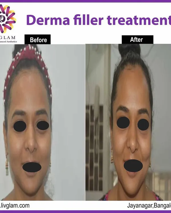 This before-and-after showcases the subtle yet impactful results of a derma filler treatment. Notice the softening of the nasolabial folds and the restored volume in the mid-face, creating a refreshed and more youthful appearance without looking unnatural.