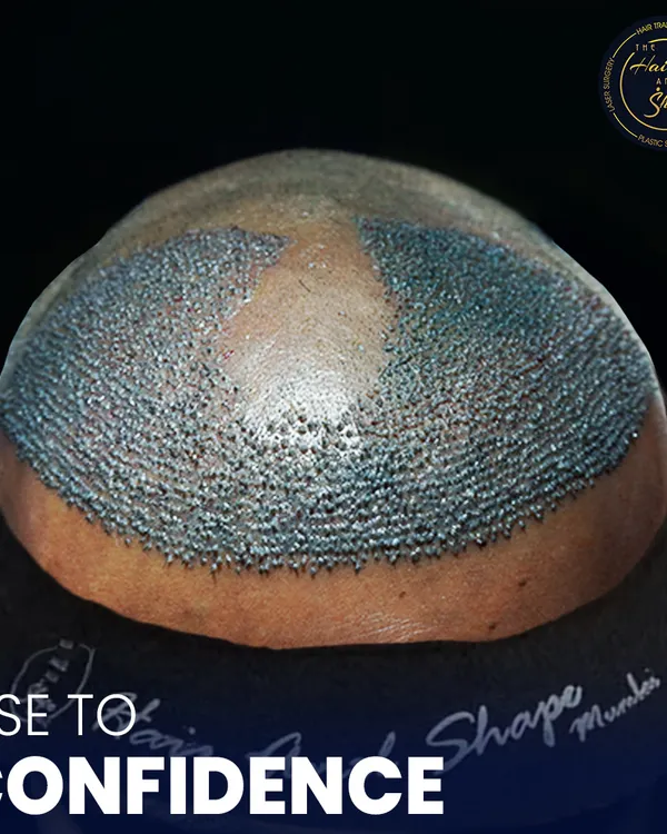 This top-down view shows the immediate result of an FUE hair transplant. You can see the newly implanted follicles creating the foundation for a fuller crown and a restored hairline.