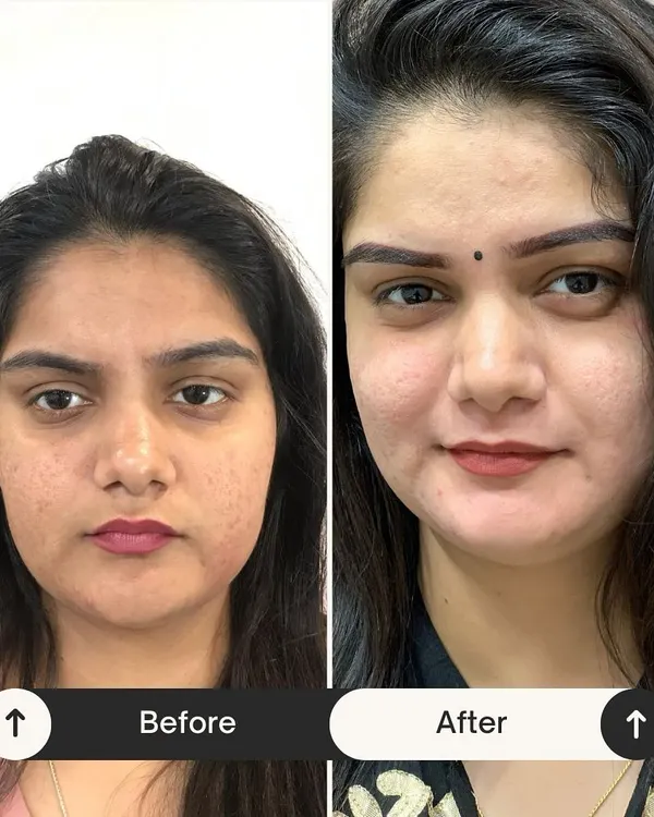 Another incredible transformation from my Miracle Facial. You can see a visible reduction in texture and a significant boost in brightness and clarity after just one session. Consistent aftercare with my products ensures these results last.