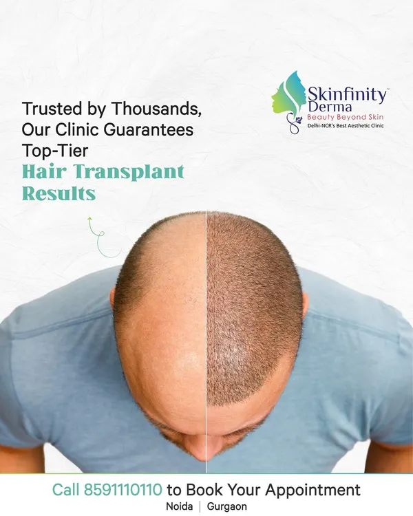 This is the power of a well-executed hair transplant. We focus on creating a natural-looking hairline and dense coverage, permanently solving hair loss concerns for our patients.