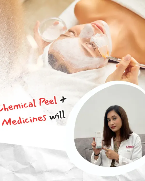 For treating acne, a combination approach is often most effective. This visual explains that a chemical peel, when paired with the right prescribed medicines, can significantly reduce acne and prevent future breakouts.