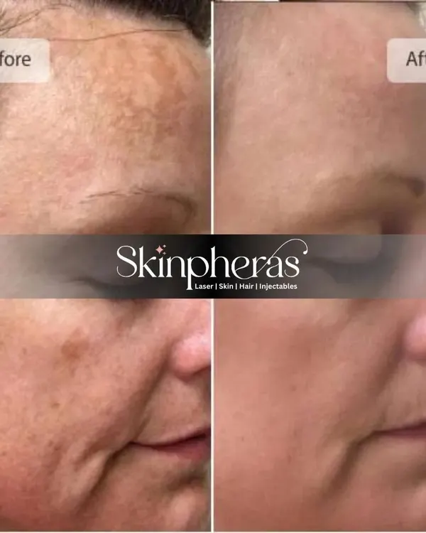 This before-and-after collage shows a significant reduction in hyperpigmentation and sun damage. Through a customized treatment plan, I was able to restore a much more even and youthful skin tone for this client.