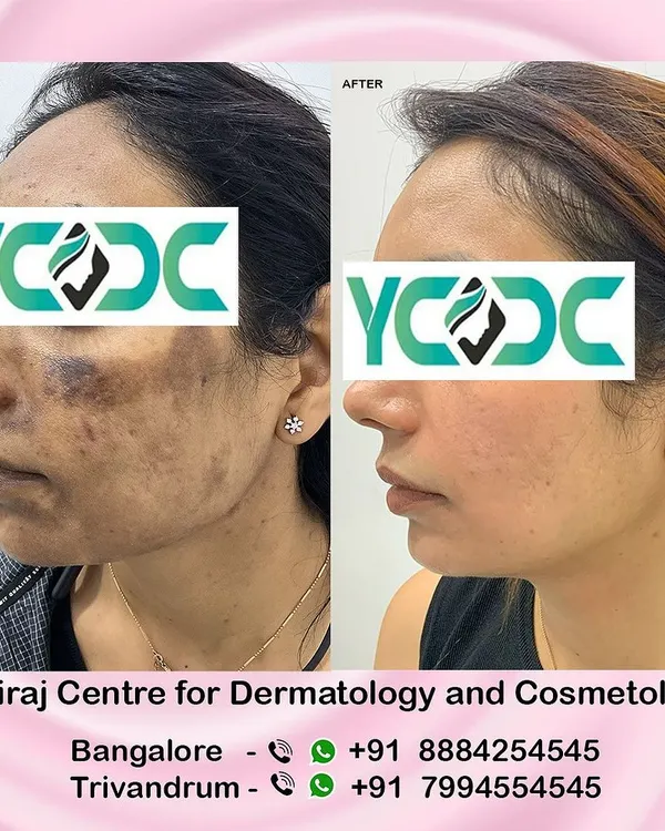 This is a powerful example of why choosing a qualified dermatologist is crucial. This patient came to me with severe pigmentation and burns after a procedure by an unqualified practitioner. I was able to restore her skin health over four months using a careful combination of advanced peels and laser treatments. Your skin is precious; always verify your doctor's credentials.