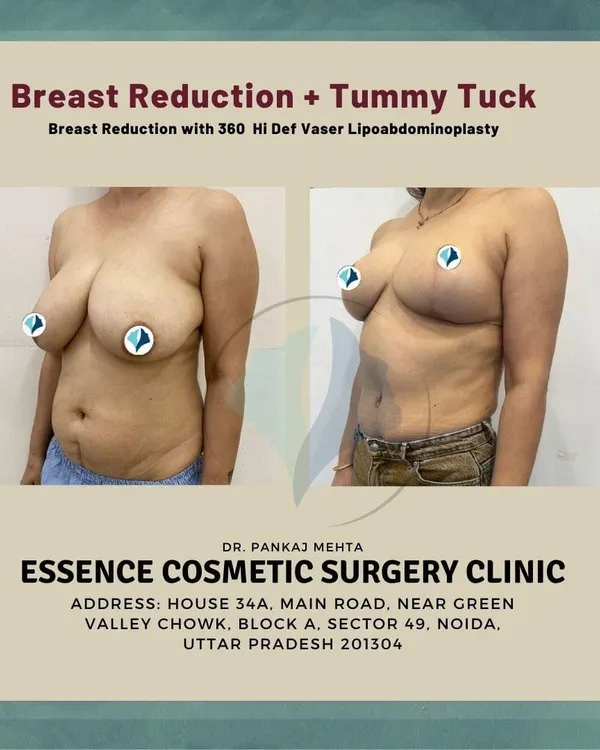 This is the result of a comprehensive Mommy Makeover, combining a breast reduction with a 360 high-definition Vaser lipoabdominoplasty. We addressed both the sagging of the breasts and the excess skin and fat on the abdomen to restore a more youthful and contoured body shape for our patient.