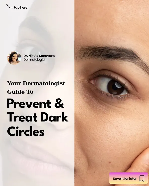 This is your complete dermatologist-led guide to preventing and treating dark circles. The first step is understanding the cause, which can range from genetics and volume loss to lifestyle factors.