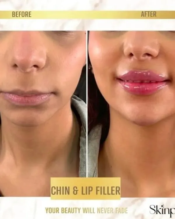 A before and after view demonstrating the power of combining chin and lip fillers. We enhanced the lip volume for a fuller pout and strengthened the chin to create a more balanced and defined side profile.