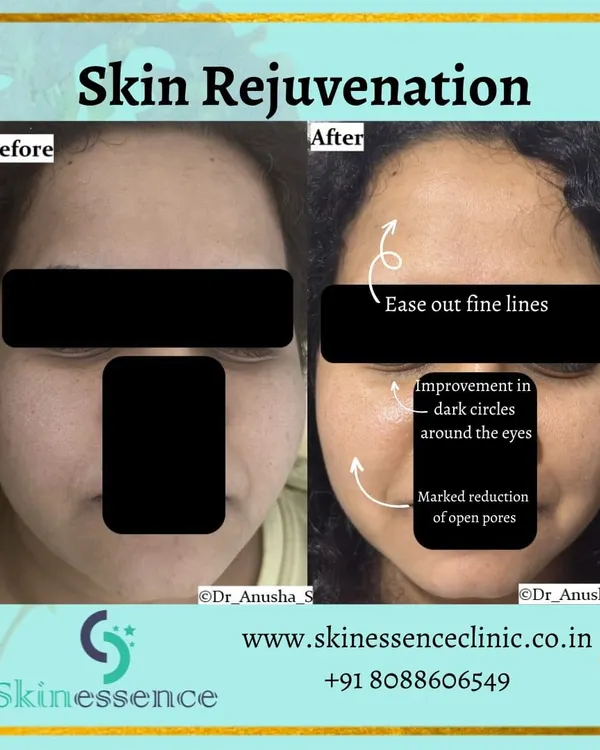 A before-and-after look at what skin rejuvenation can achieve. This patient saw a marked reduction in open pores and fine lines, along with significant improvement in under-eye dark circles, resulting in a smoother, more even complexion.
