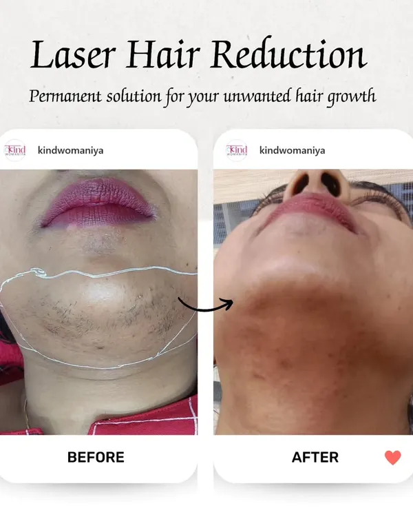 A visible reduction in chin hair after laser treatment. This before and after demonstrates how we effectively target and reduce unwanted facial hair, resulting in clear, smooth skin.