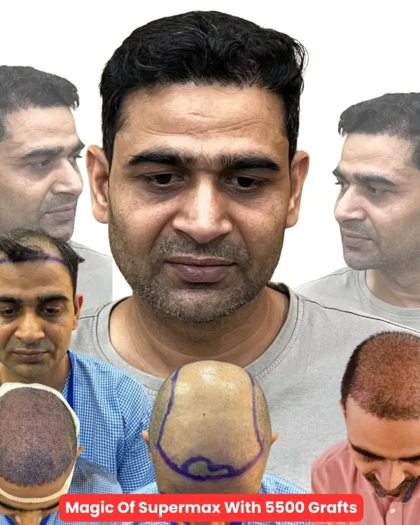 This is the magic of what I do. This collage shows the complete journey of one of my clients, from the initial consultation markings to the final, full head of hair after receiving 5500 grafts. This is not just a hair transplant; it's a life-changing transformation that I deliver.