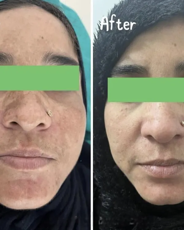 A clear example of our success in treating hyperpigmentation. Through a personalized plan including professional treatments and prescribed oral medication, we achieved a visibly more even and brighter skin tone for our client.