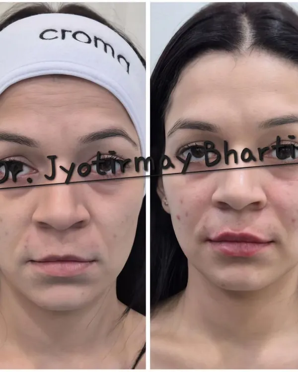This before and after shows how dermal fillers can restore youthful volume to the mid-face and soften lines around the mouth. My goal is always a subtle enhancement, helping you look rested and refreshed, not "done."