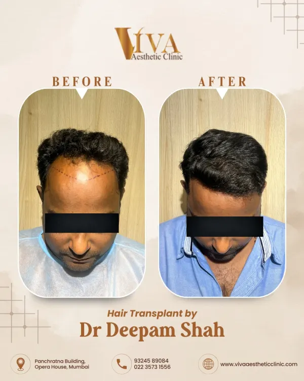 This patient came to me with Grade 3 hair loss. Using 3700 grafts, we successfully restored density to his frontal scalp and recreated a natural, age-appropriate hairline. This is the 10-month result, viewed from the top.