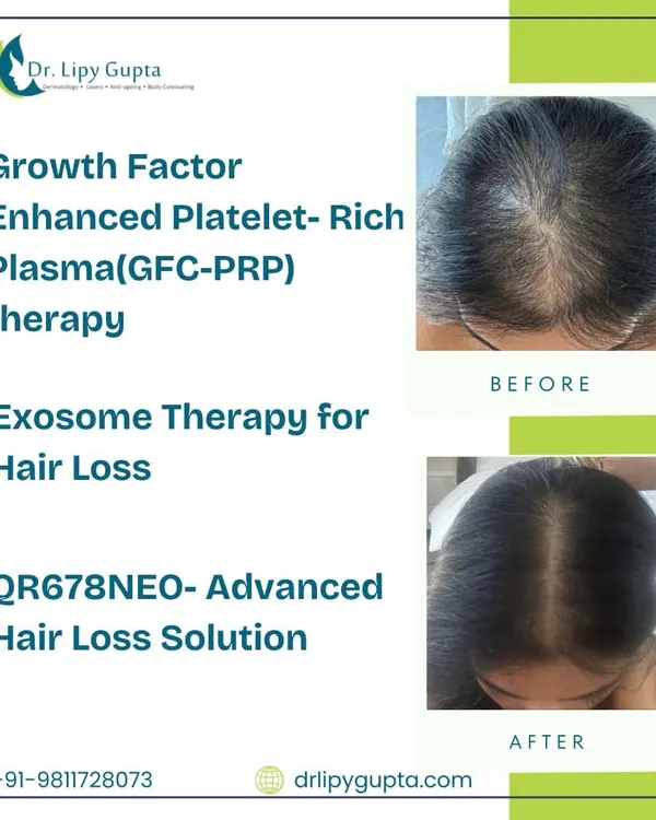 This is the kind of transformation that is possible with a consistent, medically-guided hair restoration plan. This patient's results were achieved through a combination of advanced treatments, showing a significant improvement in hair density and scalp coverage.