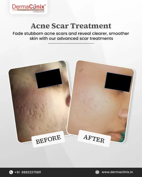 This before and after image shows the significant reduction of deep acne scars after a personalized treatment plan. We use advanced procedures like Fractional CO2 laser to resurface the skin, break down scar tissue, and stimulate new collagen growth for a smoother, clearer complexion.